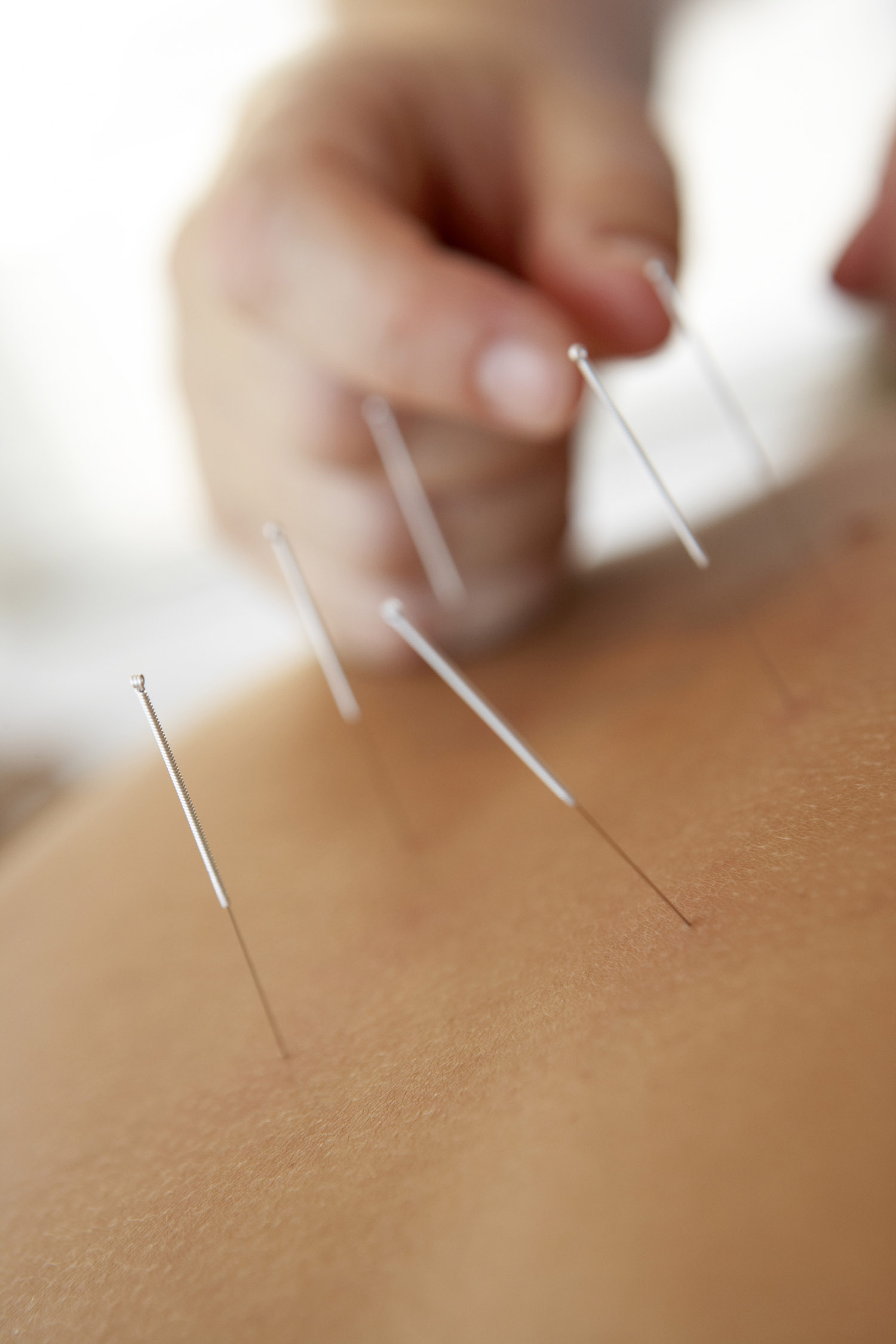 Acupuncture treatment winnipeg